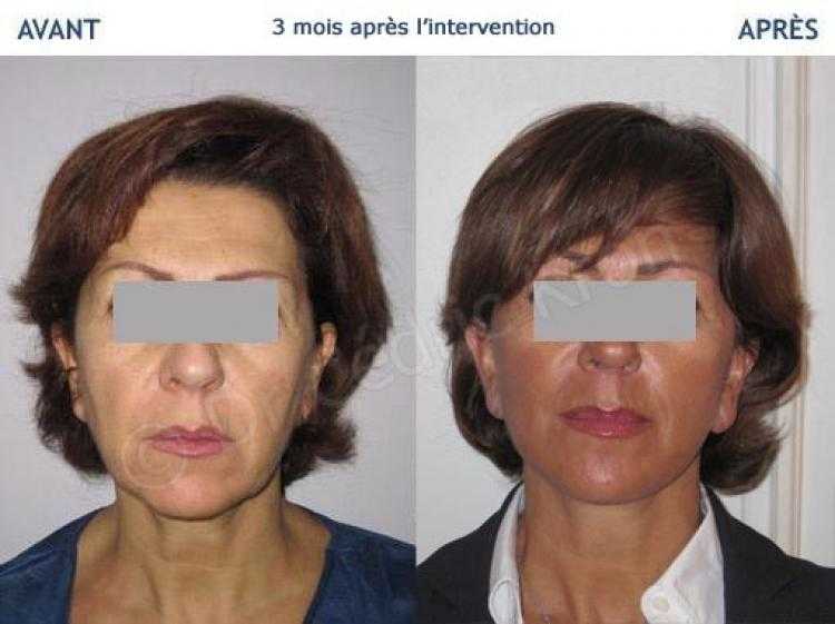 Photo Avant Apr S Lifting Cervico Facial Dr C Dric Kron