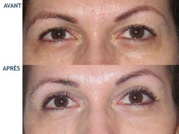 Avant Apr S De Bl Pharoplastie Chirurgie Des Paupi Res Dr Kron