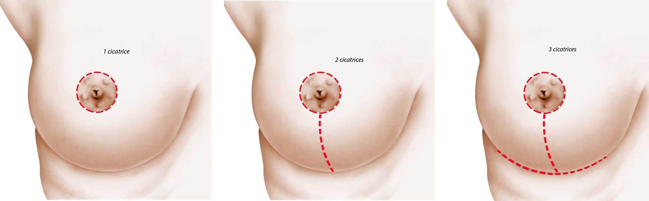 беременность и уменьшение груди фото 79