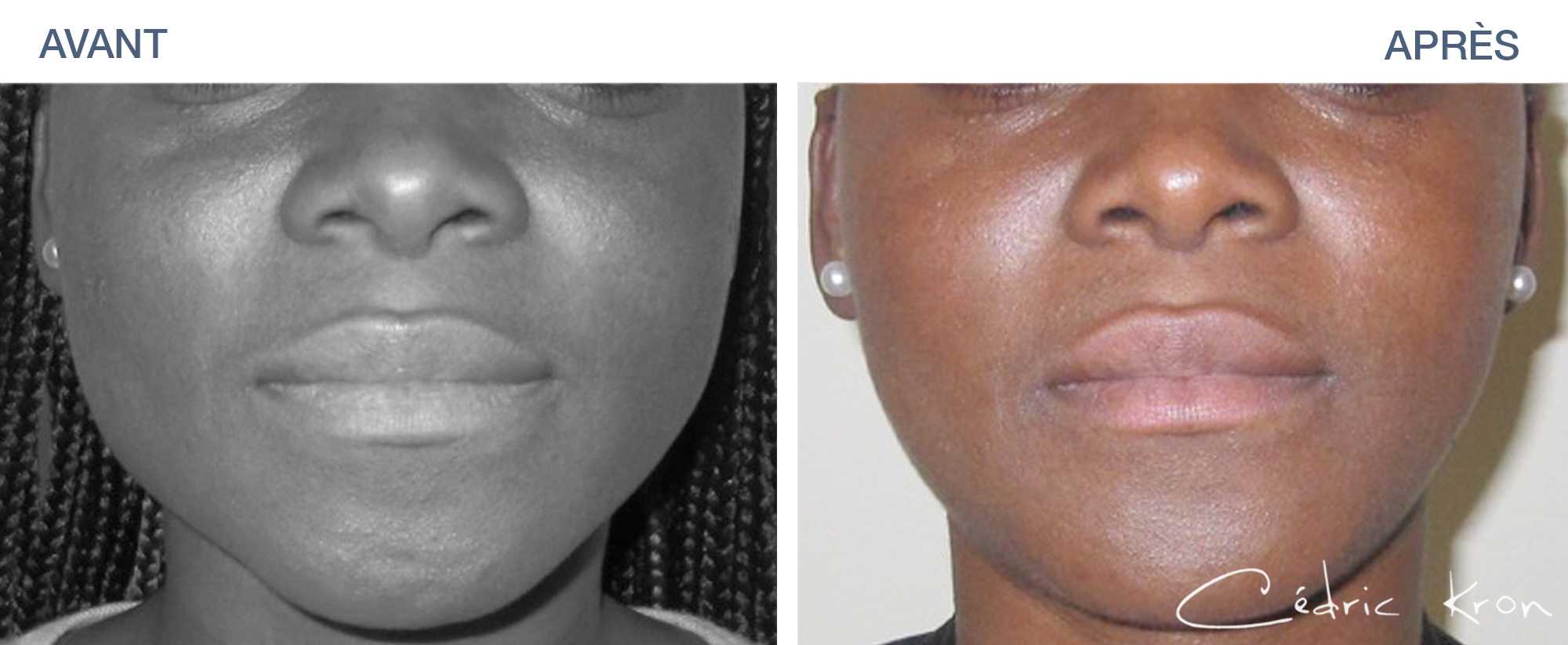 Before & After: Jaw reduction using Botox injections