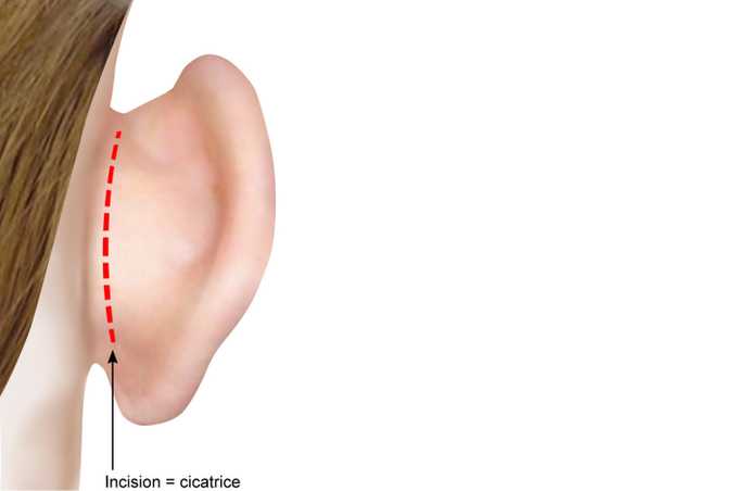 Correction des oreilles décollées à Genève - Dr Prevot, chirurgie